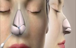The Science Behind Rhinoplasty: What to Expect